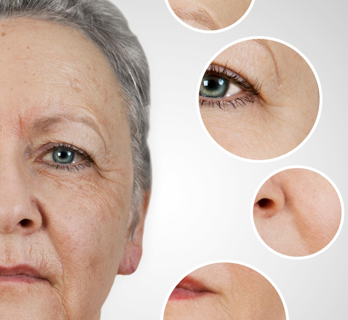 UNDERSTANDING THE LONGEVITY OF POPULAR RESTYLANE DERMAL FILLERS