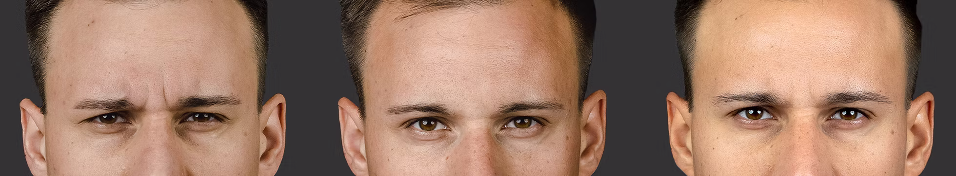<br />
three photos of the upper part of the face in men, how wrinkles changed after the procedures