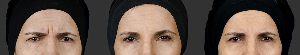 <br />
three photos of the upper part of the face in women, how wrinkles changed after the procedures