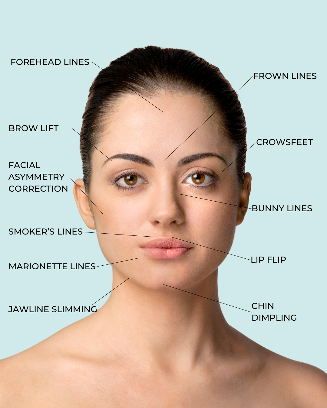 EYEBROWS Front view of woman's face with marked zones for Dysport injections: forehead lines, frown lines, crow’s feet, lip lines, chin dimpling, and masseter area.