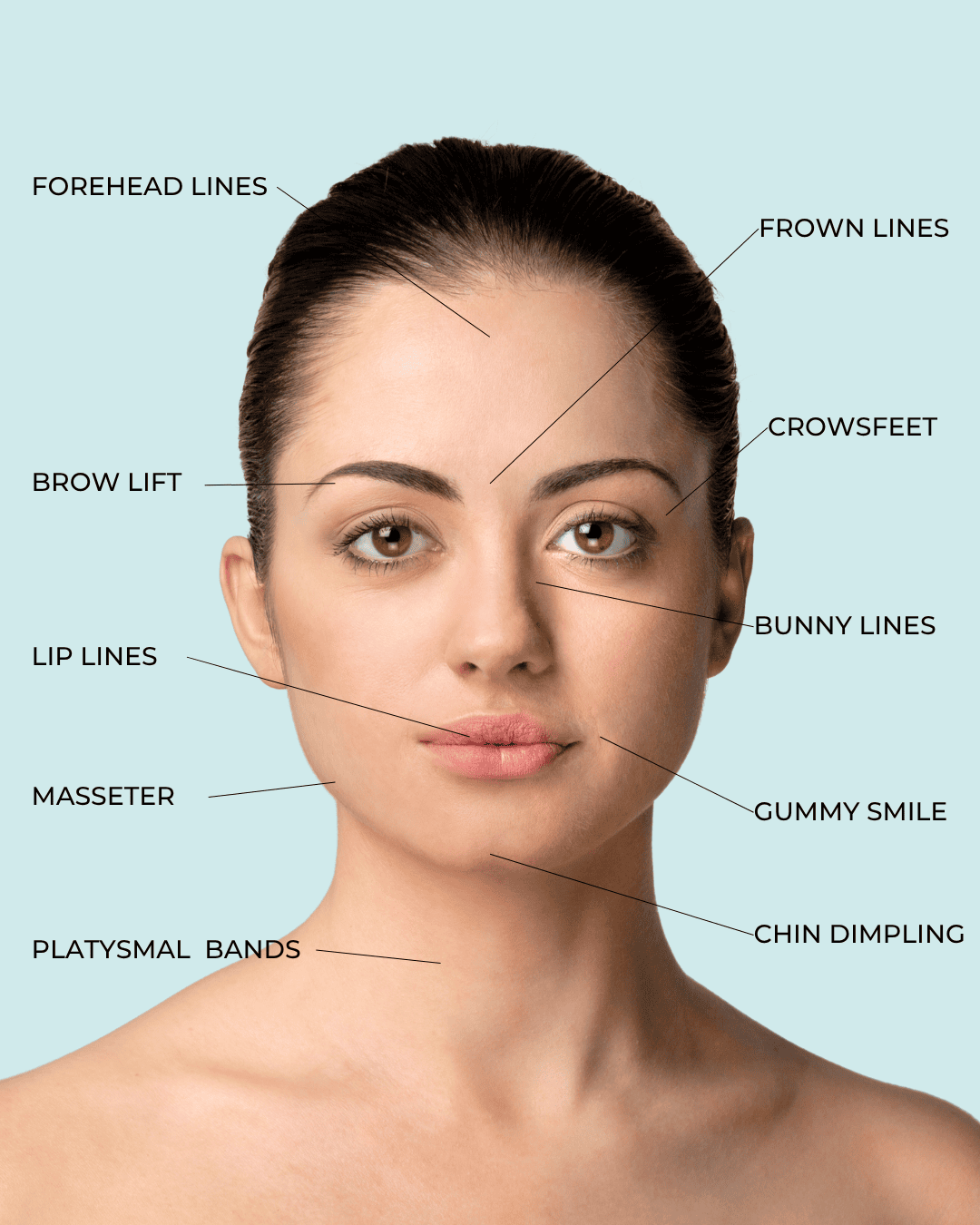 Botox injection zones for forehead lines, frown lines, crow’s feet, bunny lines, masseter, platysmal bands and more